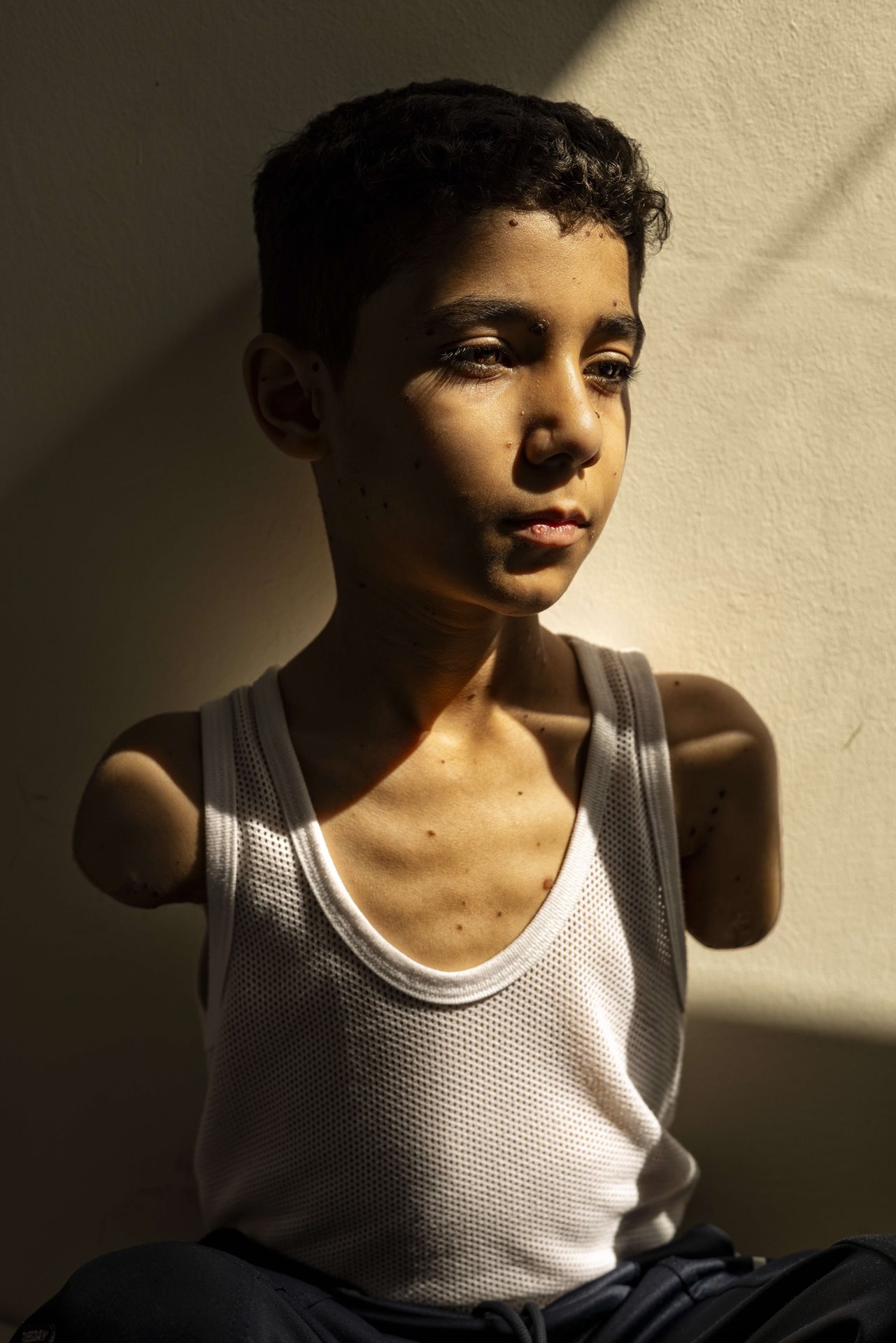 Mahmoud Ajjour (9), who was injured during an Israeli attack on Gaza City in March 2024, finds refuge and medical help in Doha, Qatar.